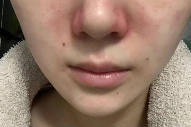10天治好鼻塞、流鼻涕！过来人分享详细教程轻松去鼻炎不复发！(图2)