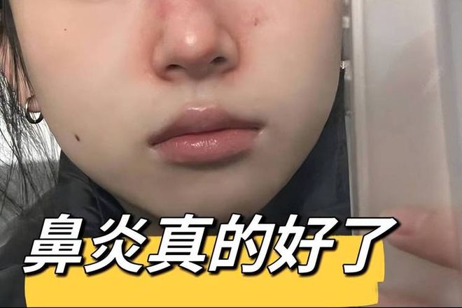 10天治好鼻塞、流鼻涕！过来人分享详细教程轻松去鼻炎不复发！(图1)