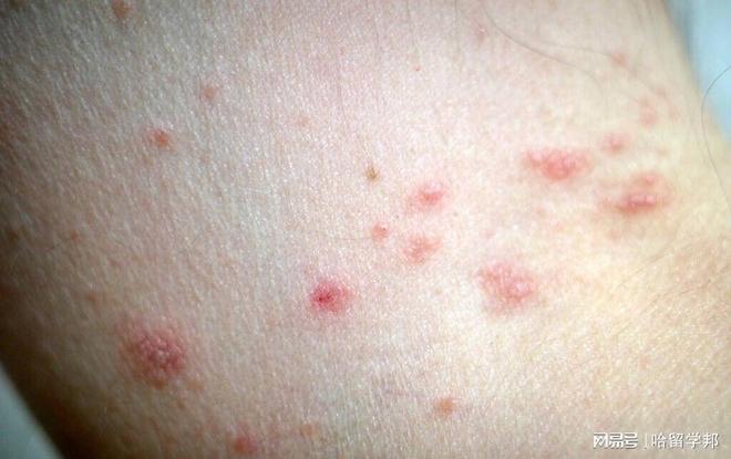 大三男生网络交友3个月感染艾滋病男男危险(图2)